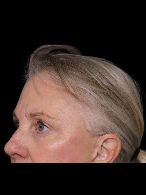 Endoscopic Browlift Gallery Before & After