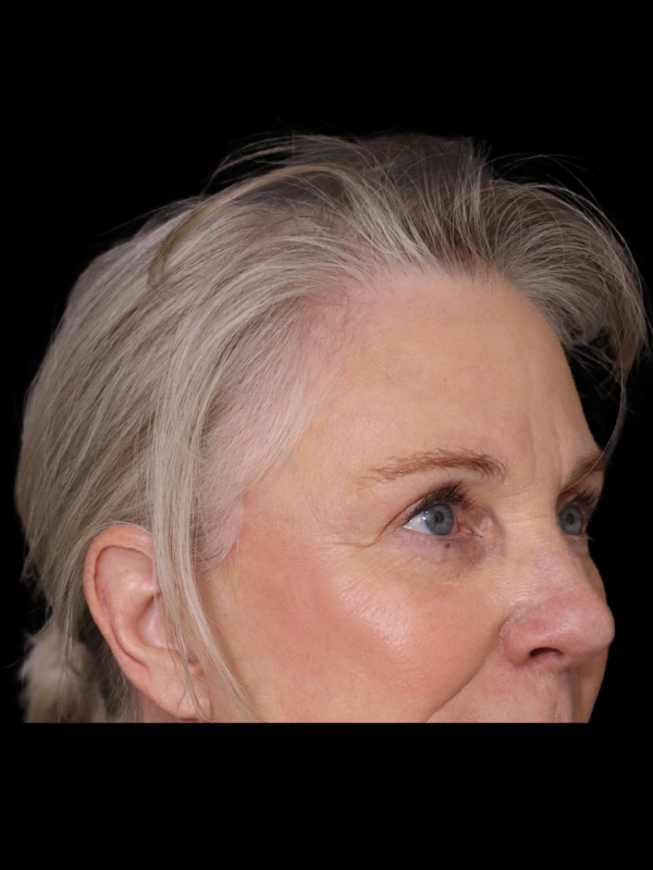 Endoscopic Browlift Gallery Before & After