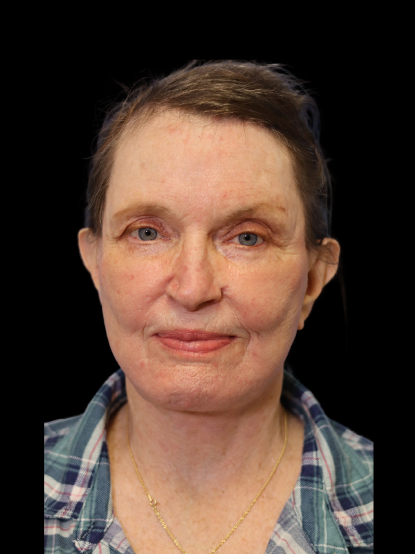 Endoscopic Browlift Gallery Before & After