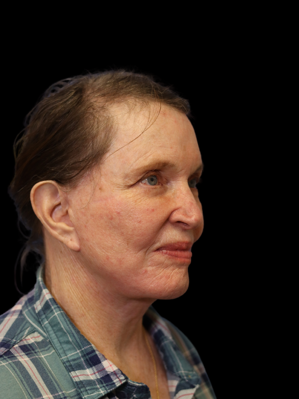 Endoscopic Browlift Gallery Before & After