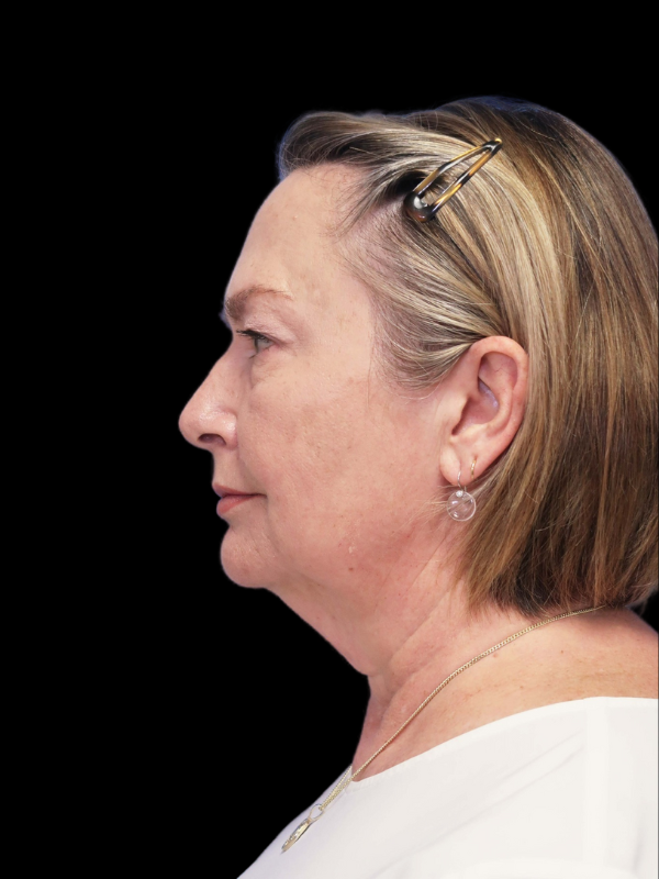 Endoscopic Browlift Gallery Before & After