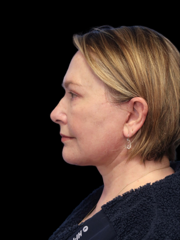 Endoscopic Browlift Gallery Before & After