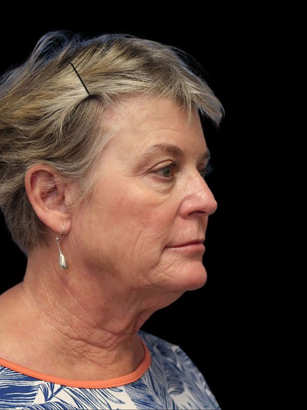 Endoscopic Browlift Gallery Before & After