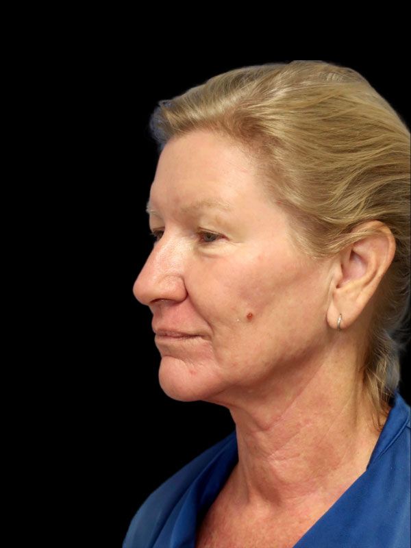 Endoscopic Browlift Gallery Before & After