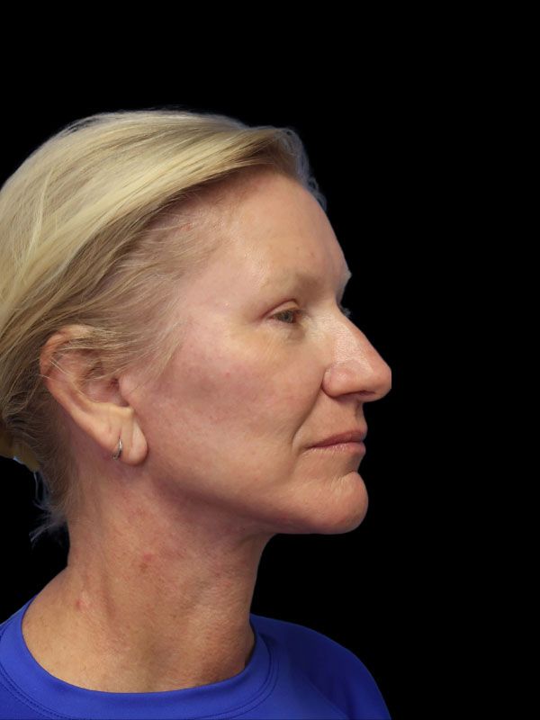 Endoscopic Browlift Gallery Before & After