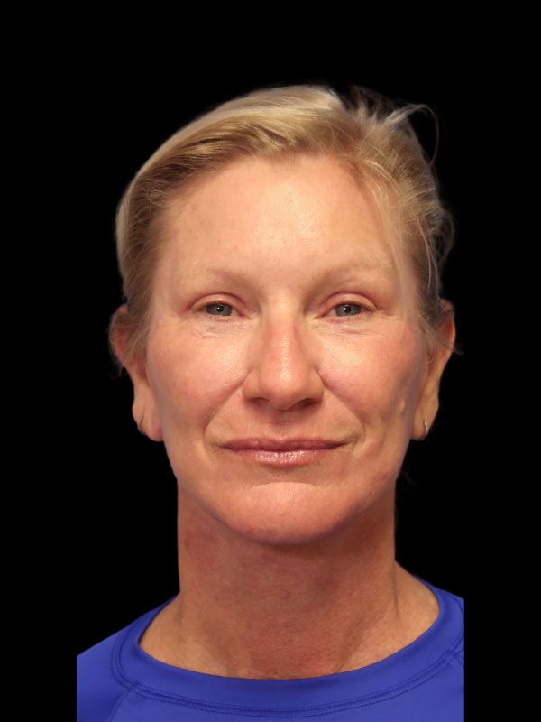 Endoscopic Browlift Gallery Before & After