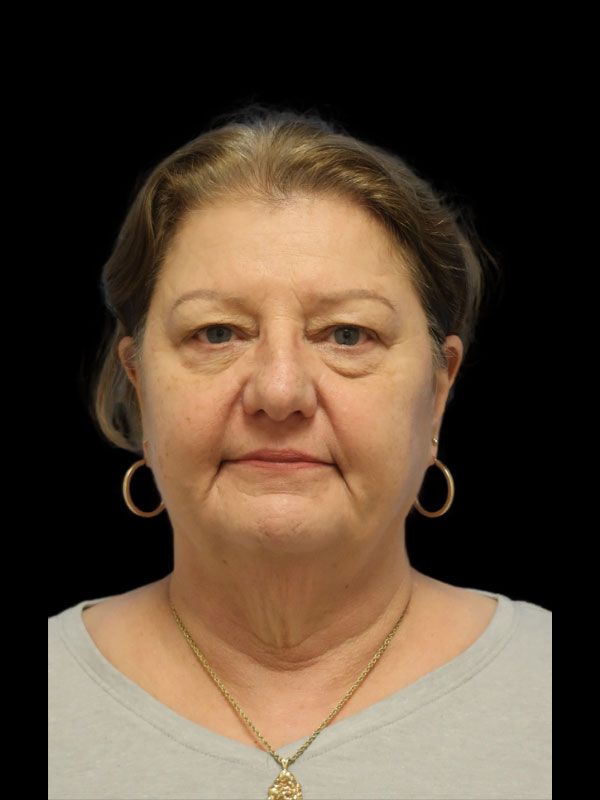 Endoscopic Browlift Gallery Before & After