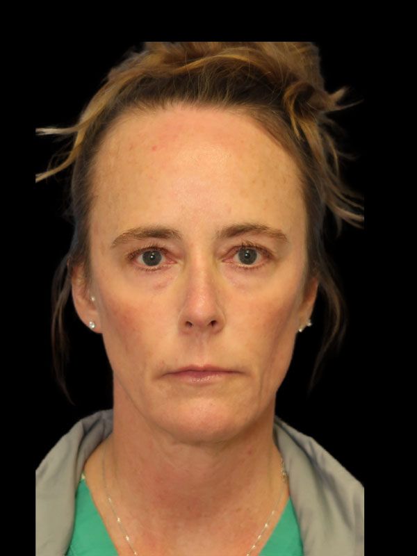 Endoscopic Browlift Gallery Before & After