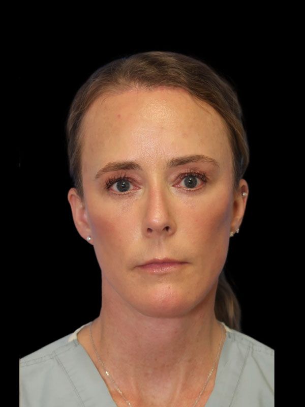 Endoscopic Browlift Gallery Before & After