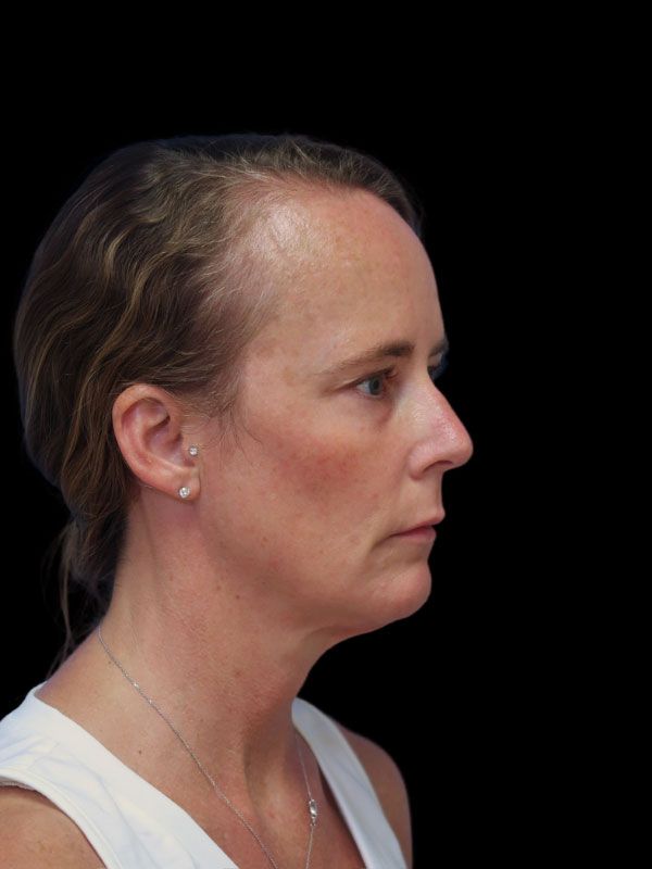 Endoscopic Browlift Gallery Before & After