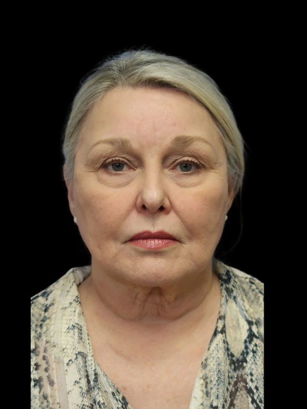 Endoscopic Browlift Gallery Before & After