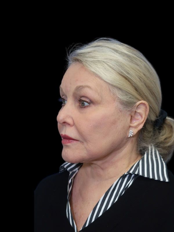 Endoscopic Browlift Gallery Before & After