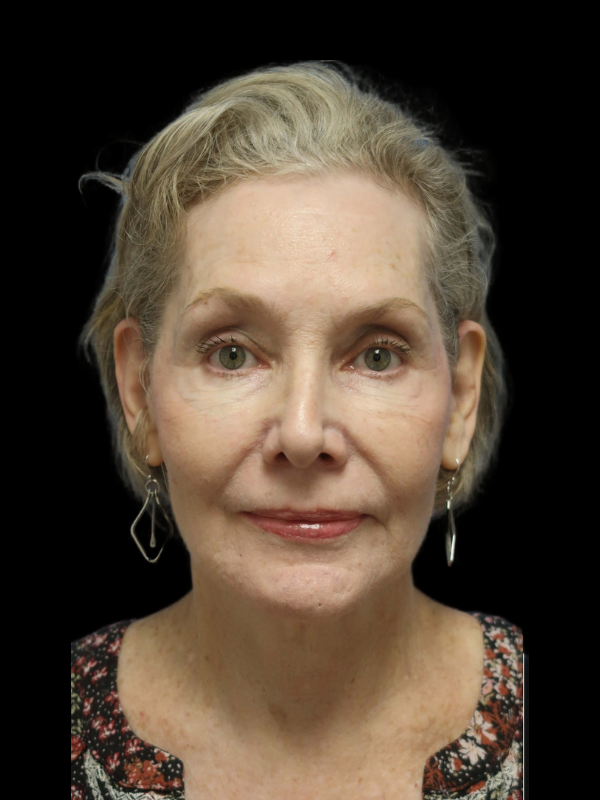 Endoscopic Browlift Gallery Before & After