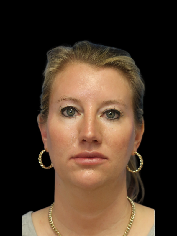 Endoscopic Browlift Gallery Before & After