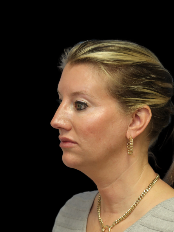 Endoscopic Browlift Gallery Before & After