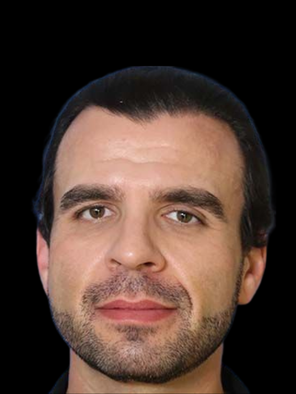 Buccal Fat Removal Before & After