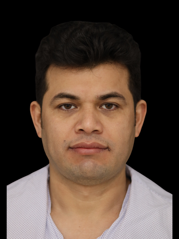 Buccal Fat Removal Before & After