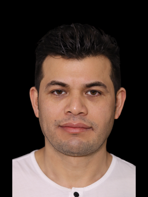 Buccal Fat Removal Before & After