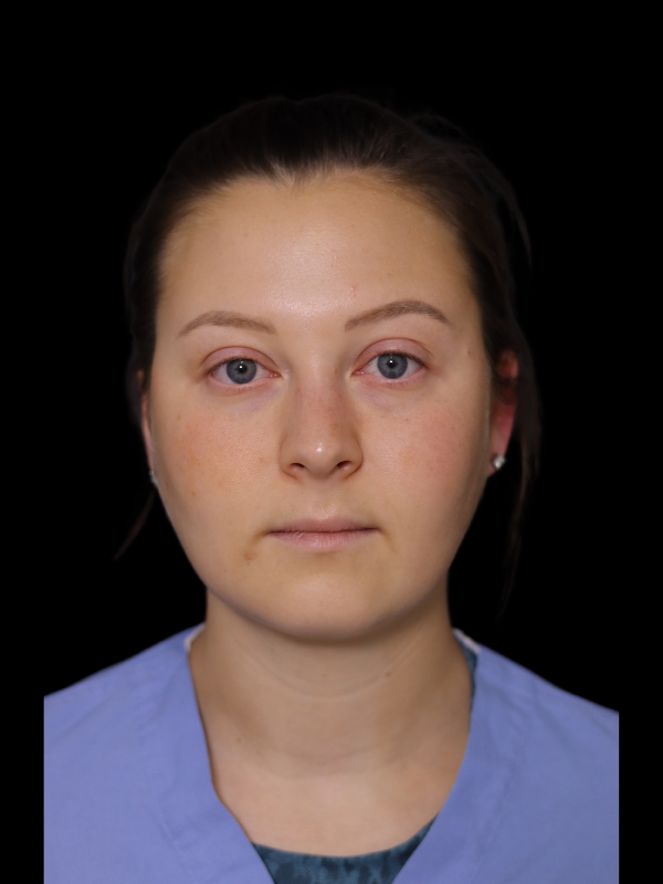 Buccal Fat Removal Before & After