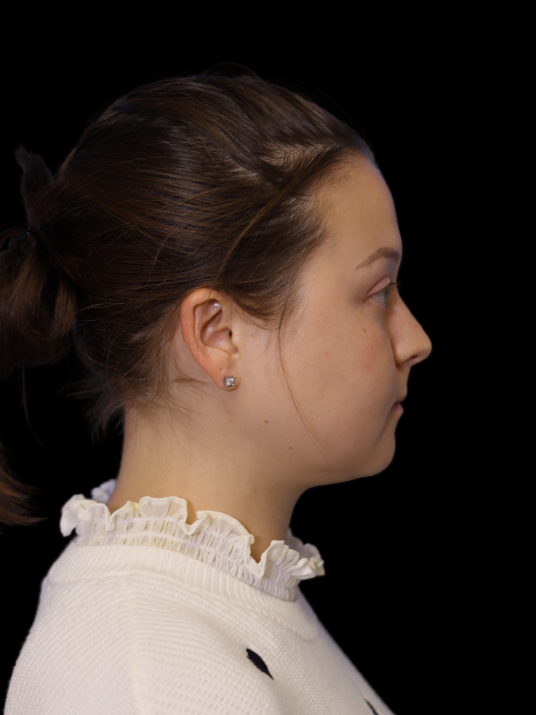 Buccal Fat Removal Before & After