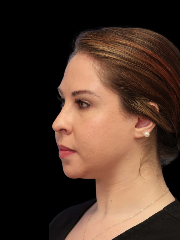 Buccal Fat Removal Before & After