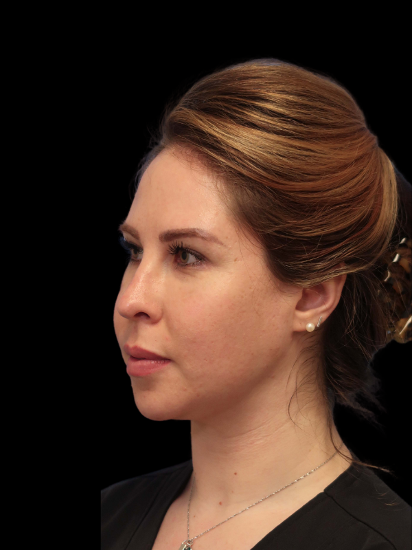 Buccal Fat Removal Before & After