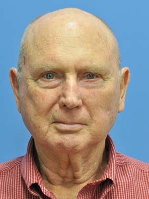 Reconstruction Before & After