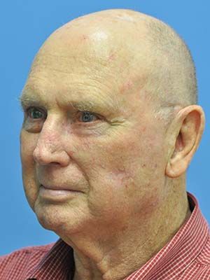 Reconstruction Before & After