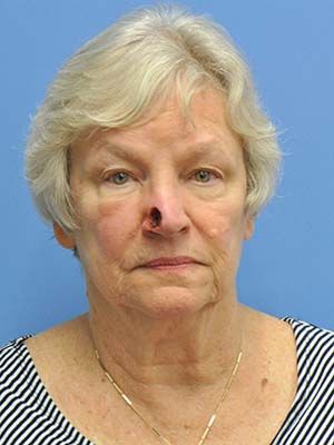 Reconstruction Before & After