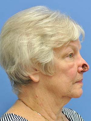 Reconstruction Before & After