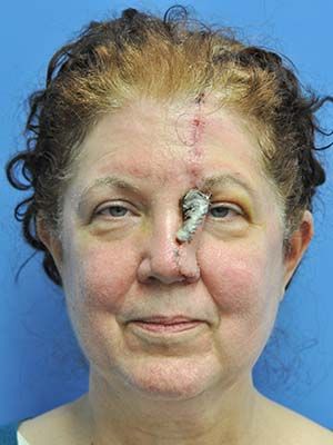 Reconstruction Before & After