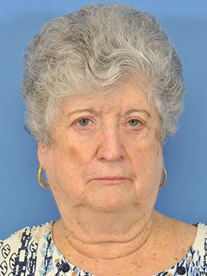 Reconstruction Before & After