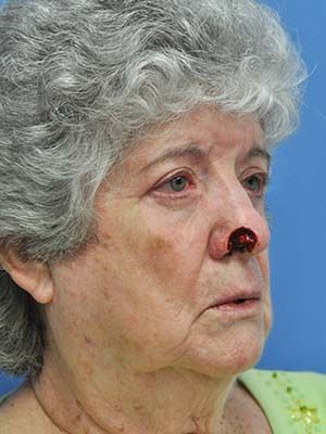 Reconstruction Before & After