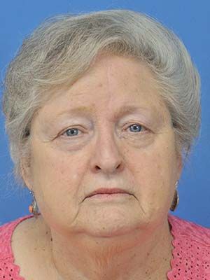 Reconstruction Before & After