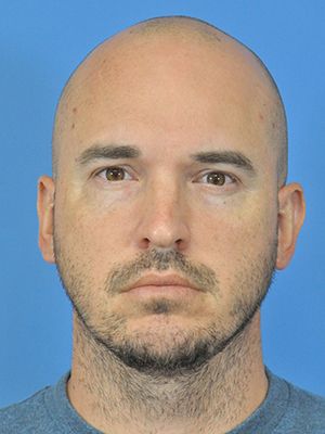 Otoplasty Before & After