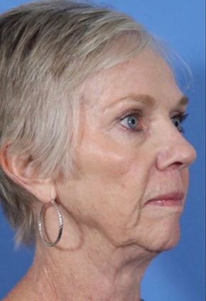 Liquid Facelift Before & After