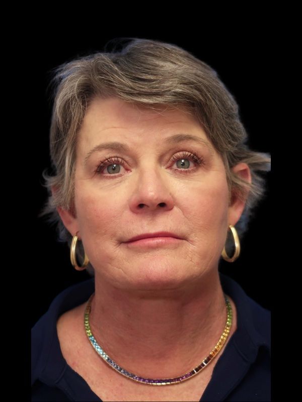 Blepharoplasty Before & After