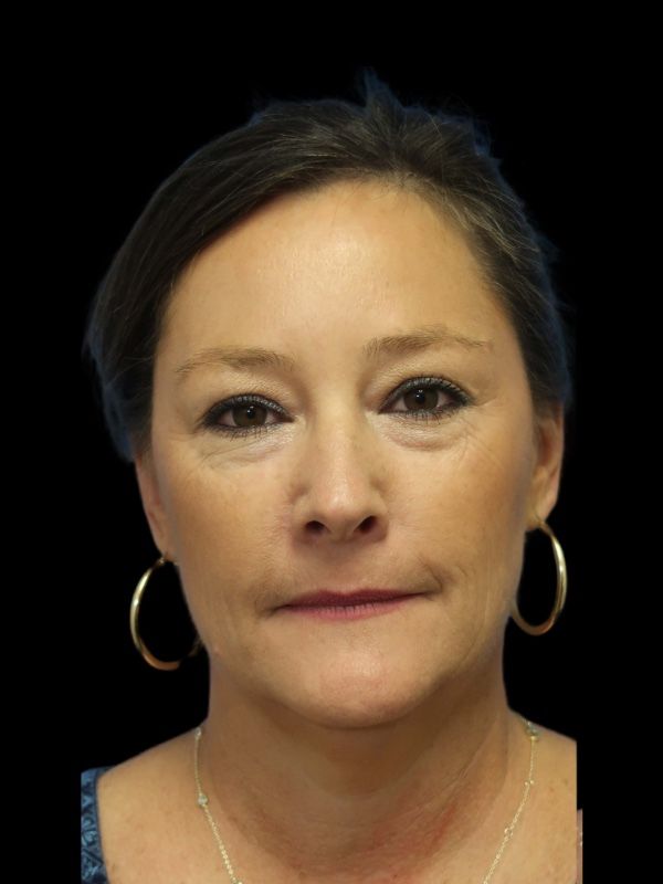 Blepharoplasty Before & After