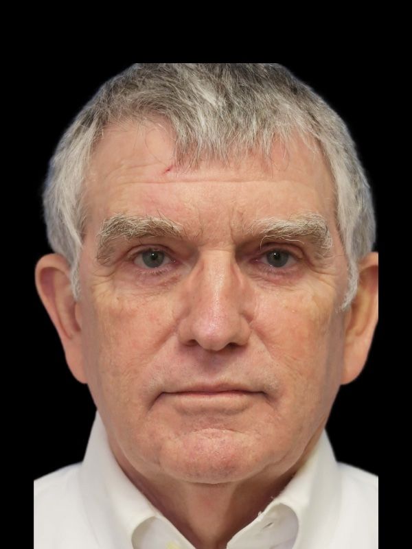 Blepharoplasty Before & After