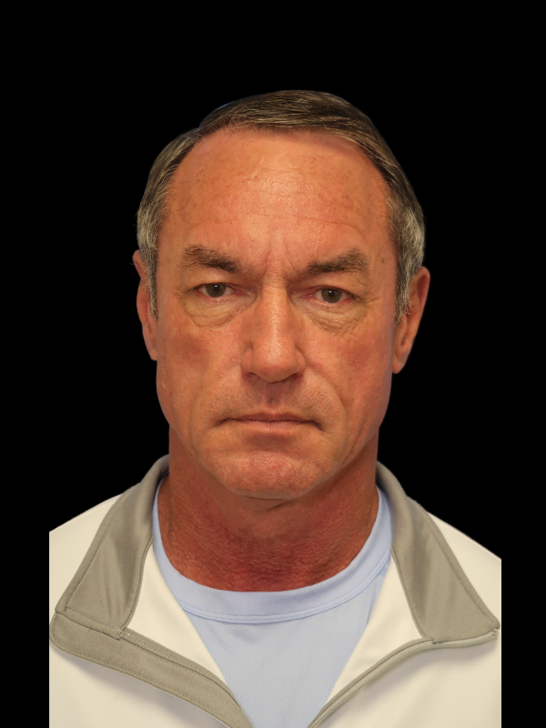 Blepharoplasty Before & After