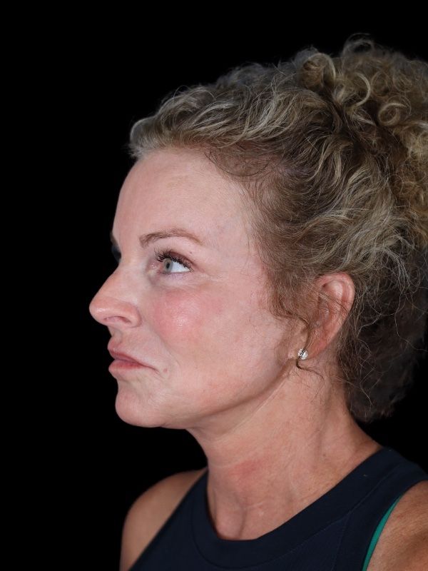 Blepharoplasty Before & After