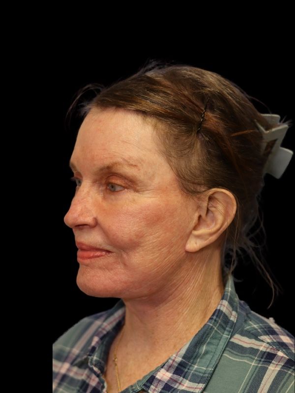 Blepharoplasty Before & After