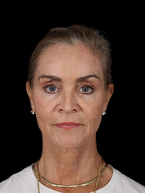 Blepharoplasty Before & After