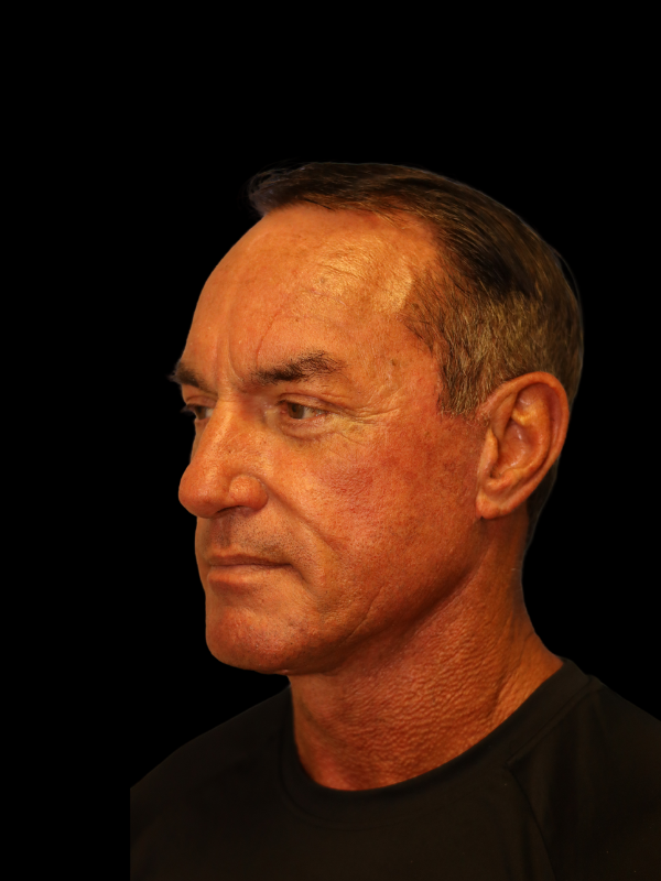 Blepharoplasty Before & After