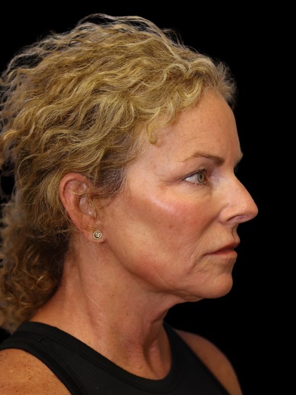 Blepharoplasty Before & After