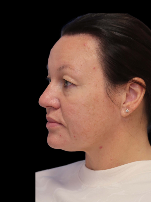 Blepharoplasty Before & After