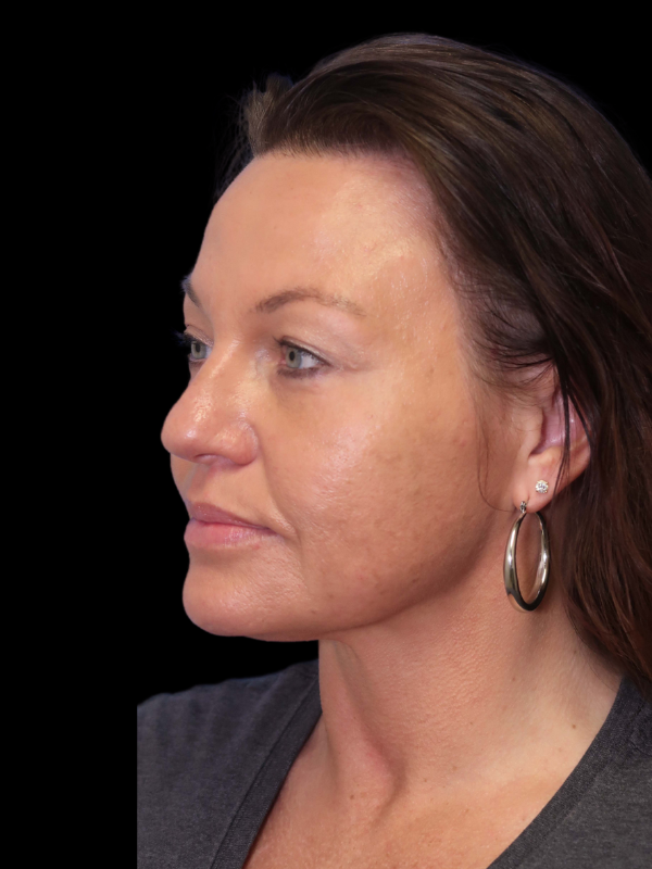 Blepharoplasty Before & After