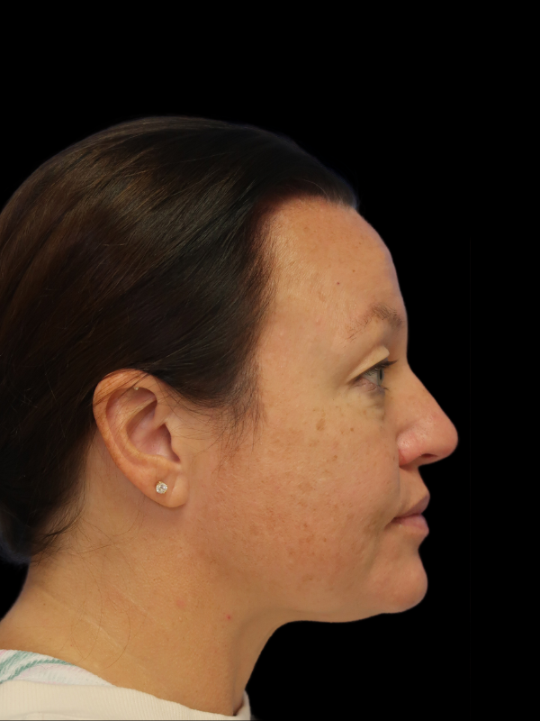 Blepharoplasty Before & After