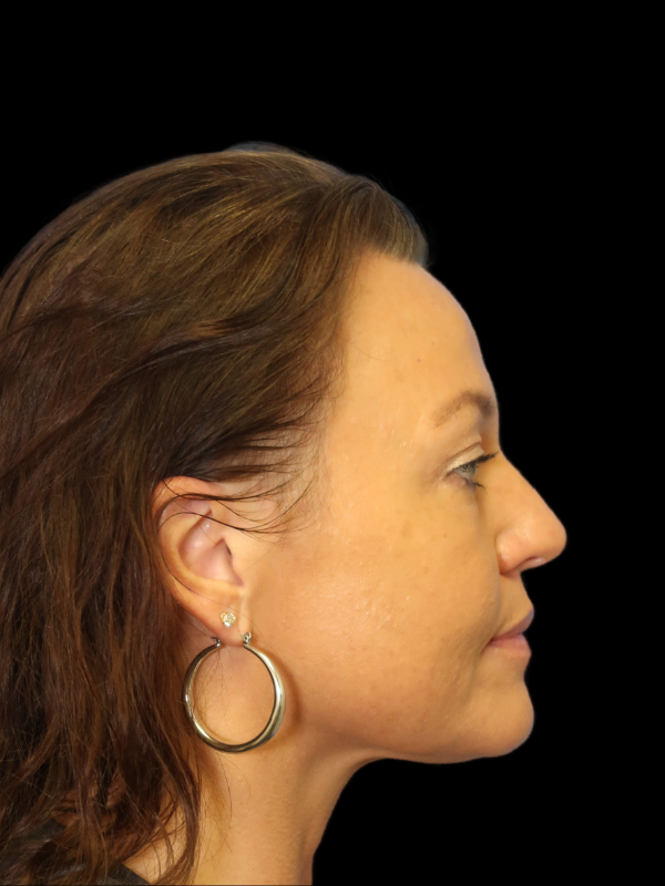 Blepharoplasty Before & After