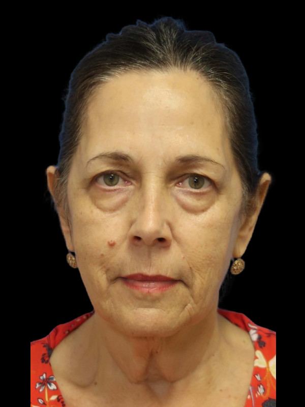 Blepharoplasty Before & After